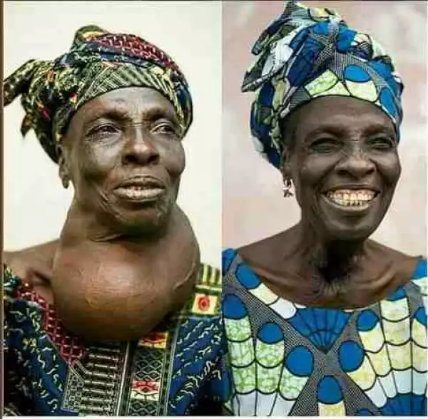 Old Woman All Smiles After Massive Goitre Attached To Her Neck Was Removed(Photos)